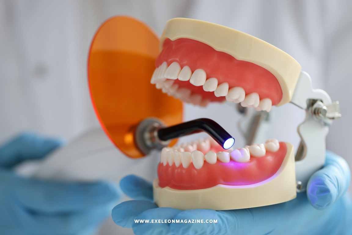 Dental Fillings