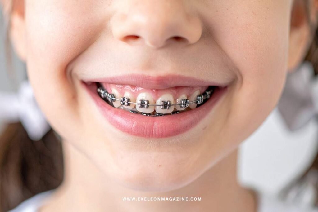 Braces
